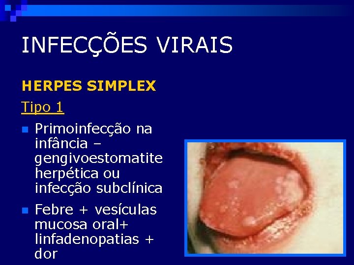 INFECÇÕES VIRAIS HERPES SIMPLEX Tipo 1 n Primoinfecção na infância – gengivoestomatite herpética ou
