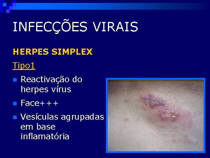 INFECÇÕES VIRAIS HERPES SIMPLEX Tipo 1 n Reactivação do herpes vírus n Face+++ n