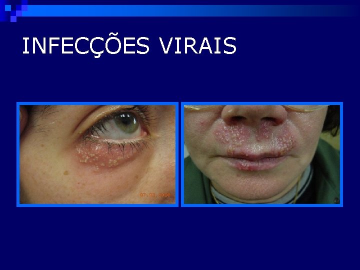 INFECÇÕES VIRAIS 