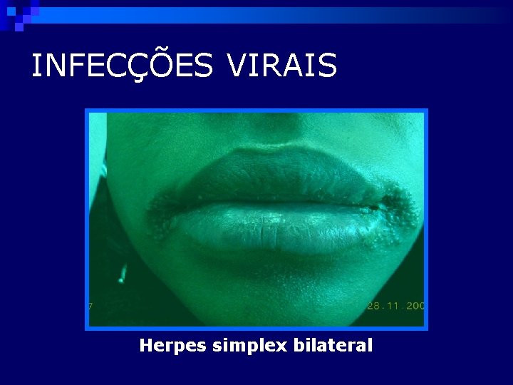 INFECÇÕES VIRAIS Herpes simplex bilateral 