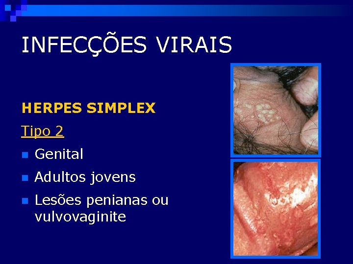 INFECÇÕES VIRAIS HERPES SIMPLEX Tipo 2 n Genital n Adultos jovens n Lesões penianas