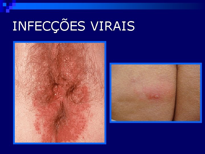 INFECÇÕES VIRAIS 