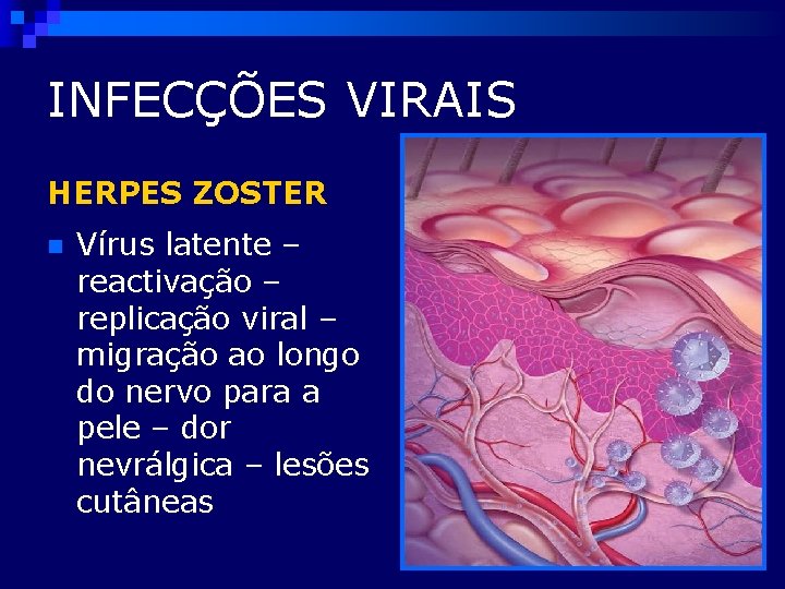 INFECÇÕES VIRAIS HERPES ZOSTER n Vírus latente – reactivação – replicação viral – migração
