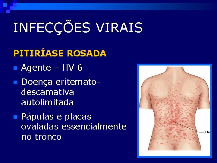 INFECÇÕES VIRAIS PITIRÍASE ROSADA n Agente – HV 6 n Doença eritematodescamativa autolimitada n