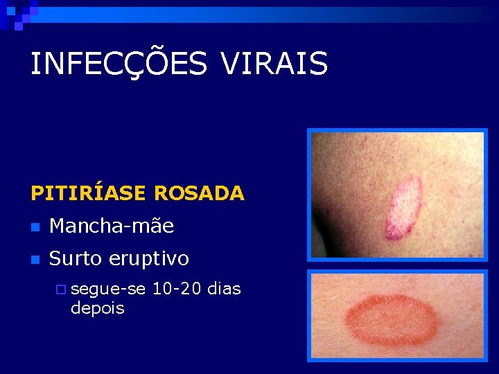 INFECÇÕES VIRAIS PITIRÍASE ROSADA n Mancha-mãe n Surto eruptivo ¨ segue-se depois 10 -20