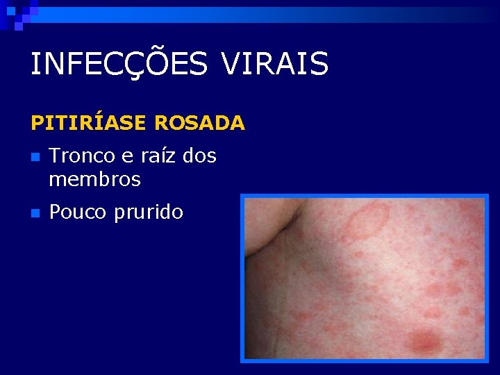 INFECÇÕES VIRAIS PITIRÍASE ROSADA n Tronco e raíz dos membros n Pouco prurido 