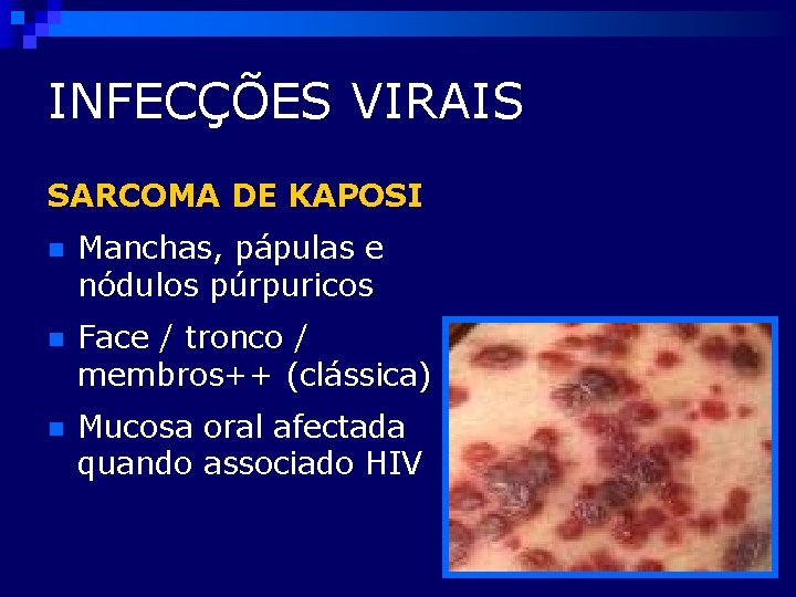 INFECÇÕES VIRAIS SARCOMA DE KAPOSI n Manchas, pápulas e nódulos púrpuricos n Face /