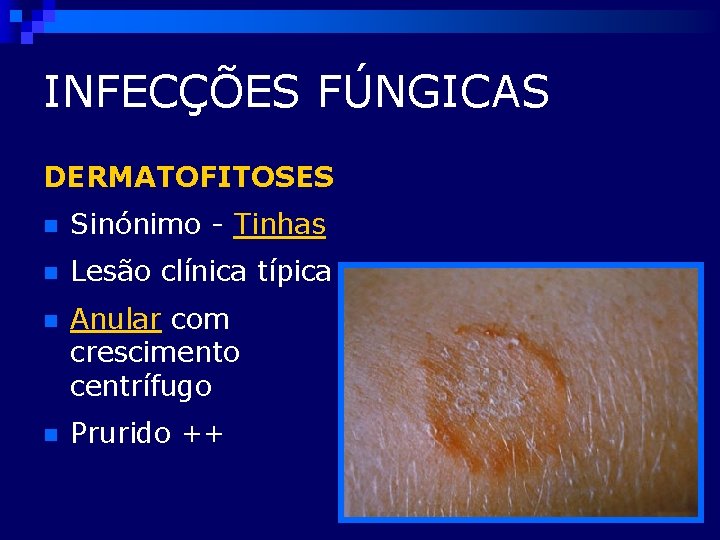 INFECÇÕES FÚNGICAS DERMATOFITOSES n Sinónimo - Tinhas n Lesão clínica típica n Anular com