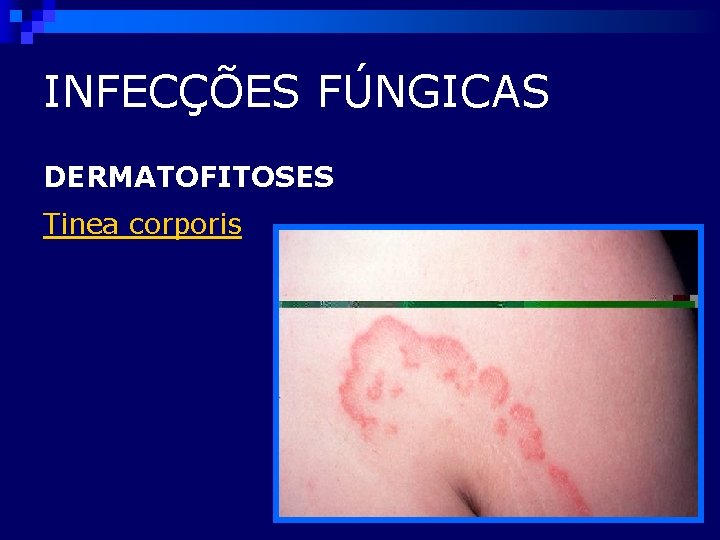 INFECÇÕES FÚNGICAS DERMATOFITOSES Tinea corporis 