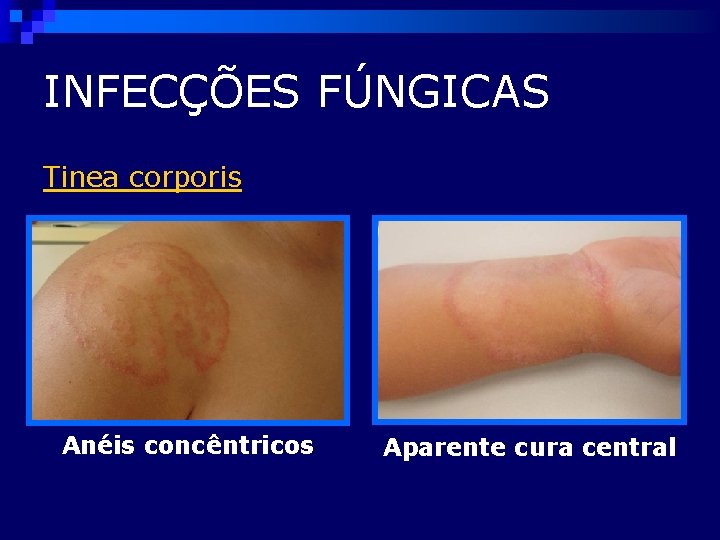 INFECÇÕES FÚNGICAS Tinea corporis Anéis concêntricos Aparente cura central 