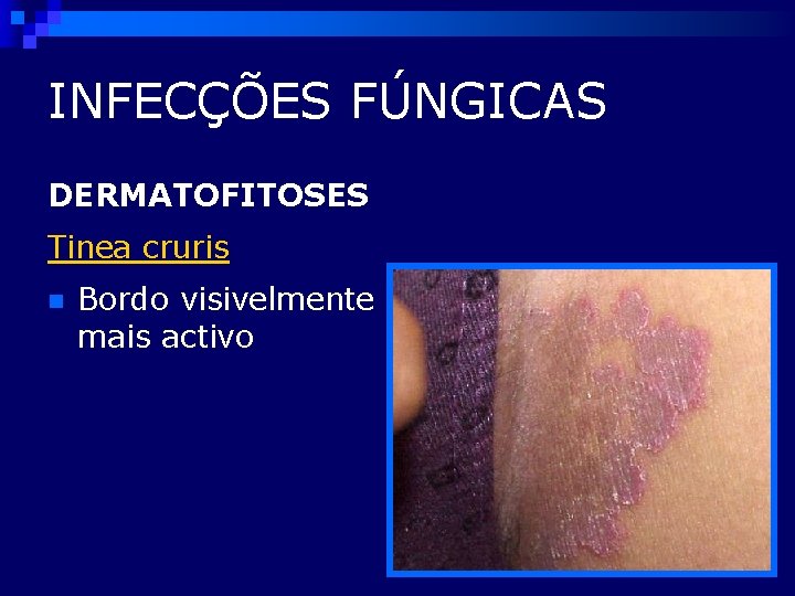 INFECÇÕES FÚNGICAS DERMATOFITOSES Tinea cruris n Bordo visivelmente mais activo 