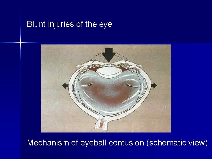 Blunt injuries of the eye Mechanism of eyeball contusion (schematic view) 