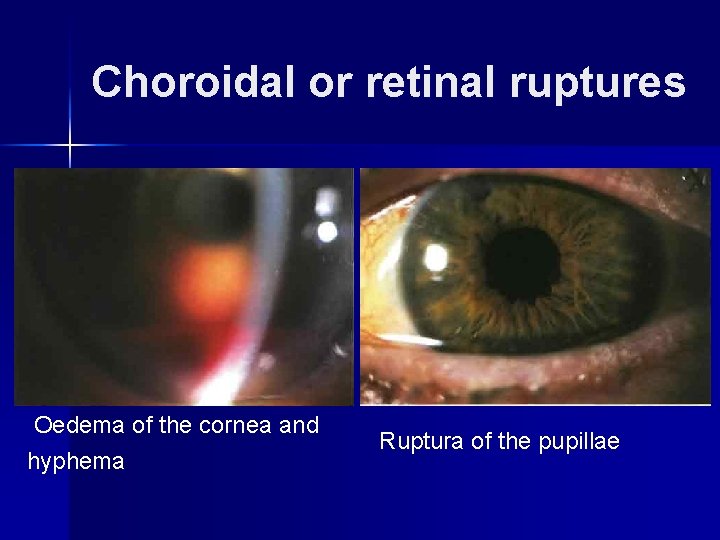 Choroidal or retinal ruptures Oedema of the cornea and hyphema Ruptura of the pupillae