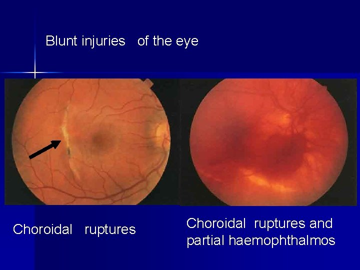 Blunt injuries of the eye Choroidal ruptures and partial haemophthalmos 