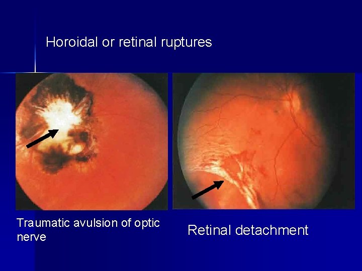 Horoidal or retinal ruptures Traumatic avulsion of optic nerve Retinal detachment 