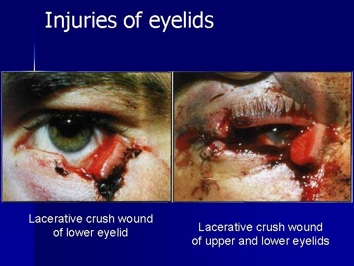 Injuries of eyelids Lacerative crush wound of lower eyelid Lacerative crush wound of upper