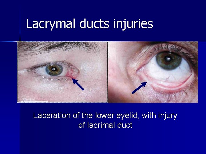 Lacrymal ducts injuries Laceration of the lower eyelid, with injury of lacrimal duct 