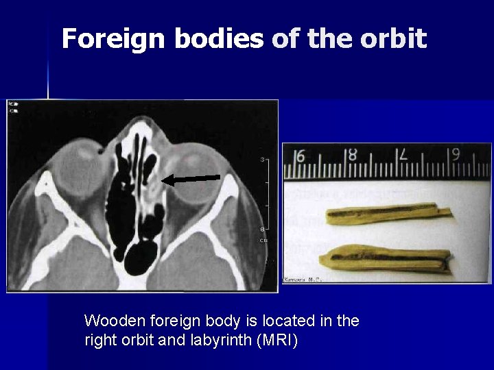 Foreign bodies of the orbit Wooden foreign body is located in the right orbit