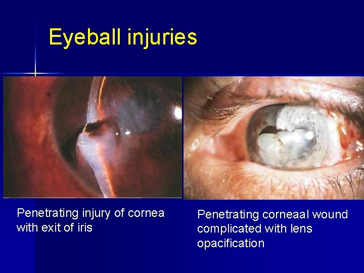 Eyeball injuries Penetrating injury of cornea with exit of iris Penetrating corneaal wound complicated