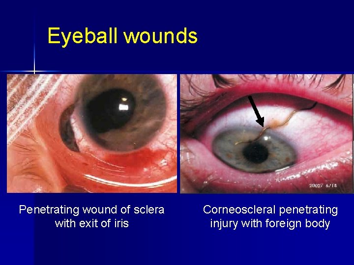Eyeball wounds Penetrating wound of sclera with exit of iris Corneoscleral penetrating injury with