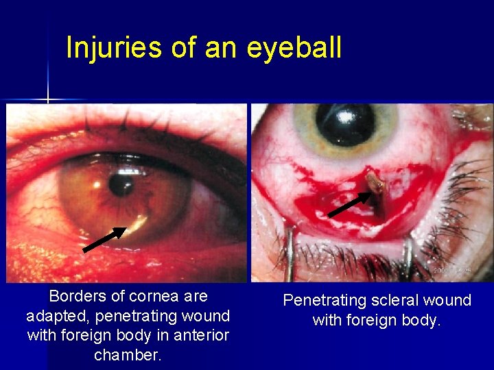Injuries of an eyeball Borders of cornea are adapted, penetrating wound with foreign body