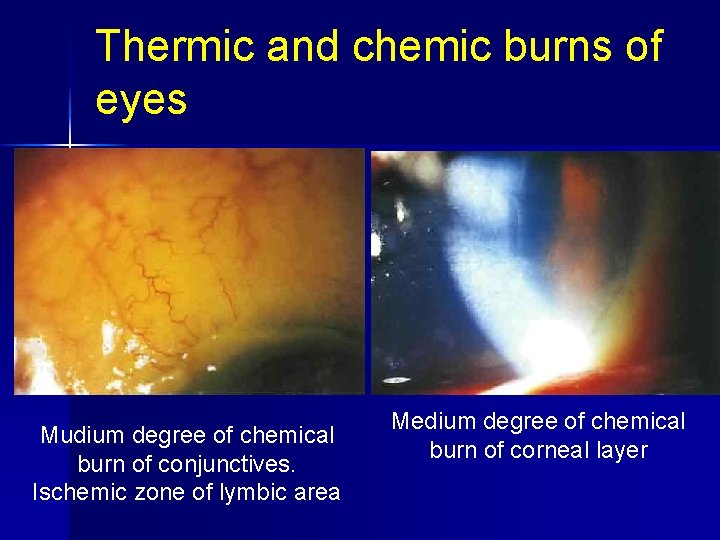 Thermic and chemic burns of eyes Mudium degree of chemical burn of conjunctives. Ischemic