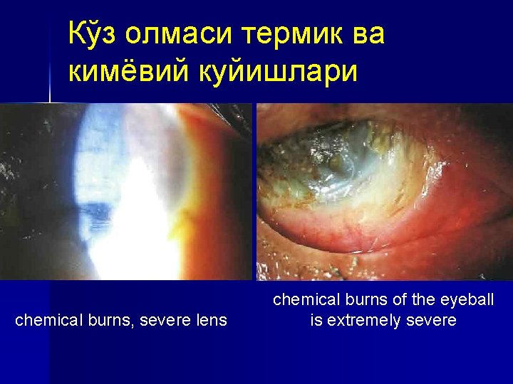 Кўз олмаси термик ва кимёвий куйишлари chemical burns, severe lens chemical burns of the