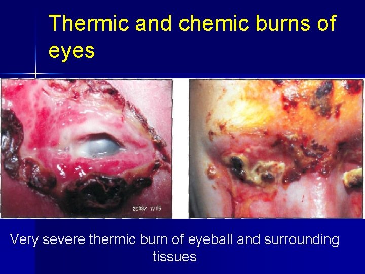 Thermic and chemic burns of eyes Very severe thermic burn of eyeball and surrounding