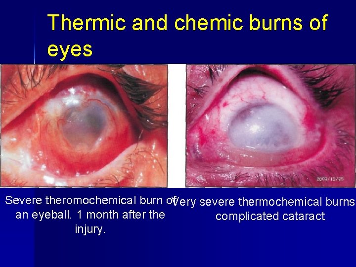 Thermic and chemic burns of eyes Severe theromochemical burn of. Very severe thermochemical burns,