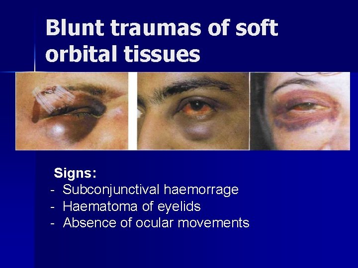 Blunt traumas of soft orbital tissues Signs: - Subconjunctival haemorrage - Haematoma of eyelids