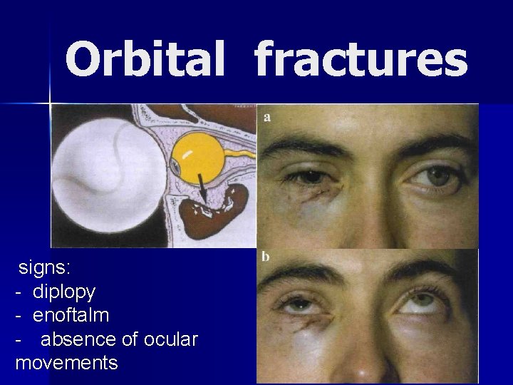 Orbital fractures signs: - diplopy - enoftalm - absence of ocular movements 