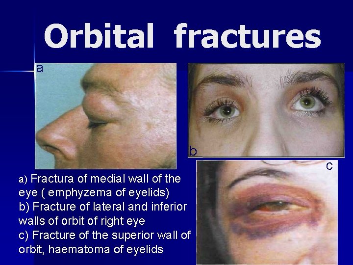 Orbital fractures а b a) Fractura of medial wall of the eye ( emphyzema