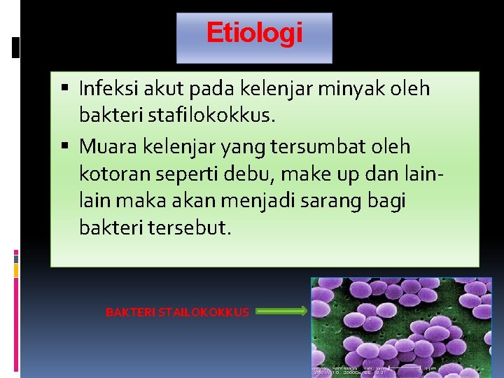 Etiologi Infeksi akut pada kelenjar minyak oleh bakteri stafilokokkus. Muara kelenjar yang tersumbat oleh