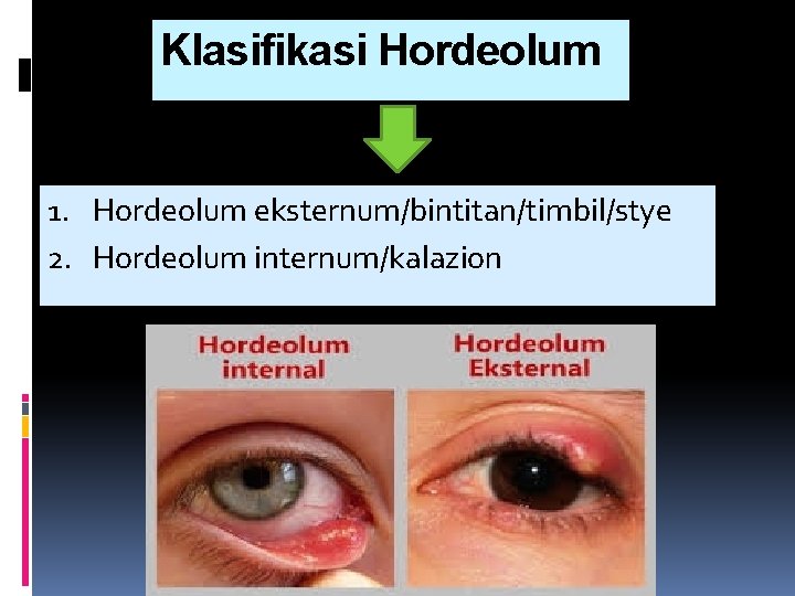 Klasifikasi Hordeolum 1. Hordeolum eksternum/bintitan/timbil/stye 2. Hordeolum internum/kalazion 