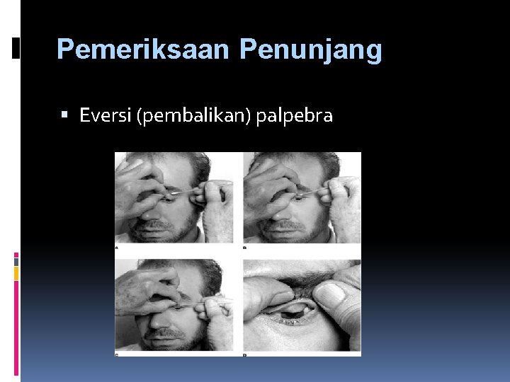 Pemeriksaan Penunjang Eversi (pembalikan) palpebra 