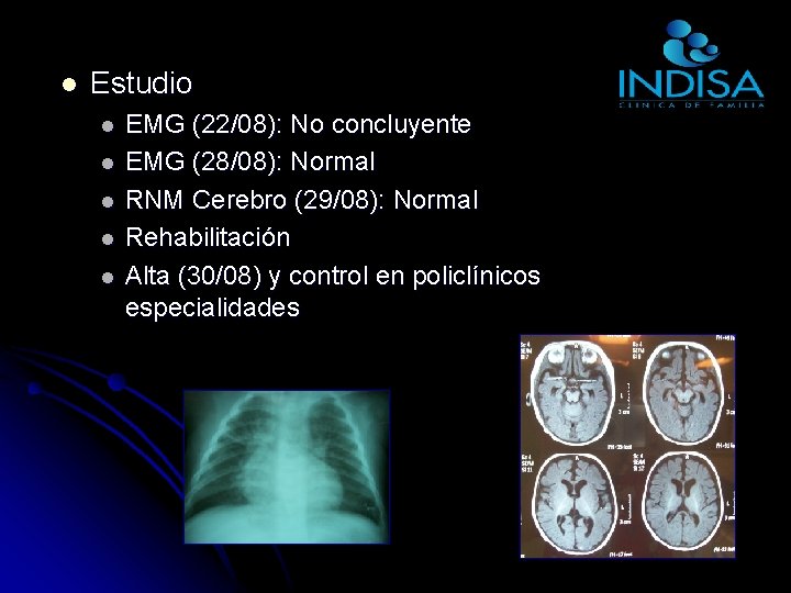 l Estudio l l l EMG (22/08): No concluyente EMG (28/08): Normal RNM Cerebro