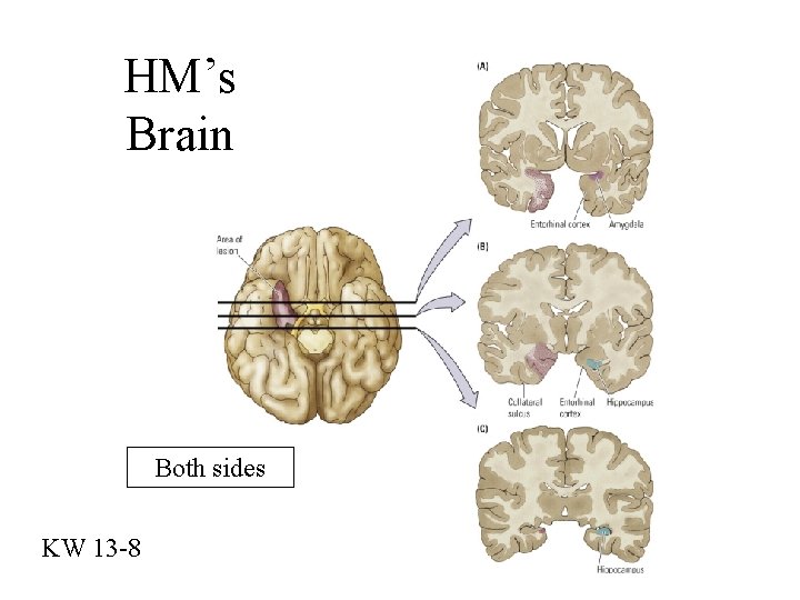 HM’s Brain Both sides KW 13 -8 