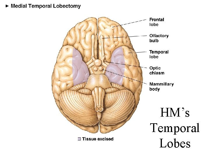 HM’s Temporal Lobes 