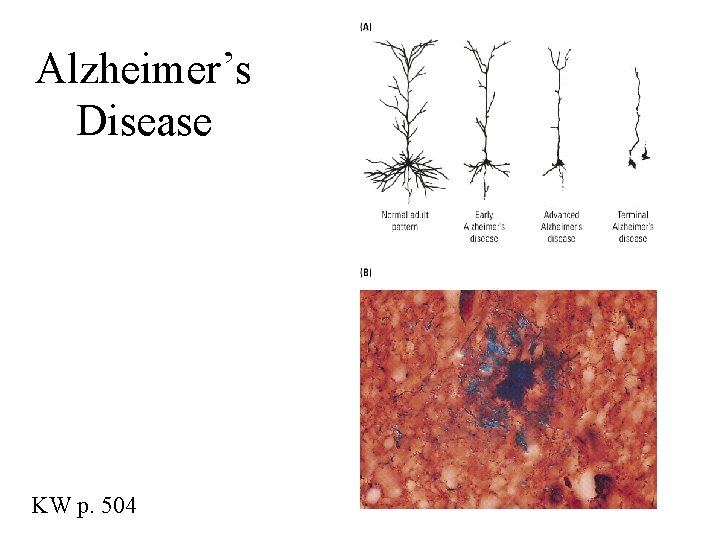 Alzheimer’s Disease KW p. 504 
