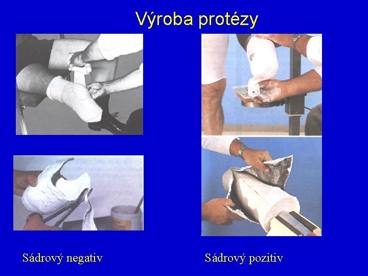 Výroba protézy Sádrový negativ Sádrový pozitiv 