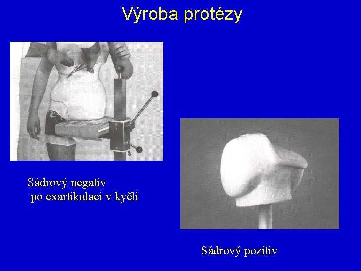 Výroba protézy Sádrový negativ po exartikulaci v kyčli Sádrový pozitiv 