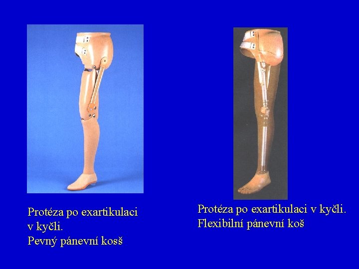 Protéza po exartikulaci v kyčli. Pevný pánevní kosš Protéza po exartikulaci v kyčli. Flexibilní