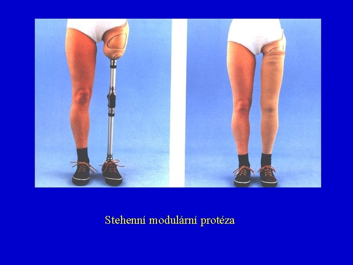 Stehenní modulární protéza 