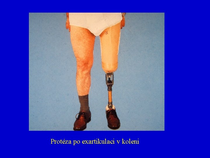 Protéza po exartikulaci v koleni 