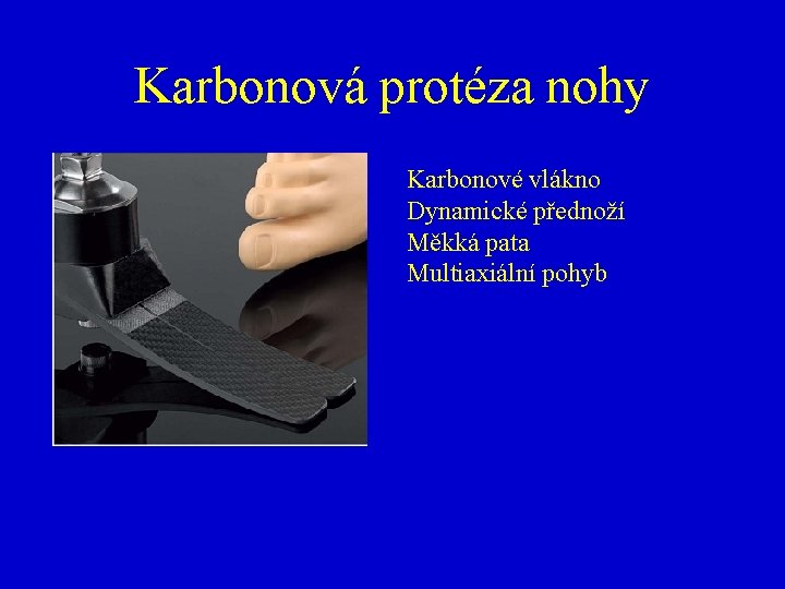 Karbonová protéza nohy Karbonové vlákno Dynamické přednoží Měkká pata Multiaxiální pohyb 