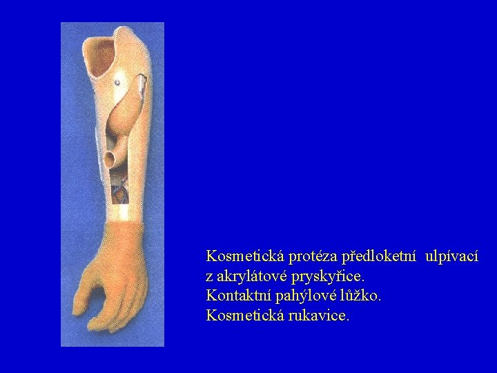 Kosmetická protéza předloketní ulpívací z akrylátové pryskyřice. Kontaktní pahýlové lůžko. Kosmetická rukavice. 