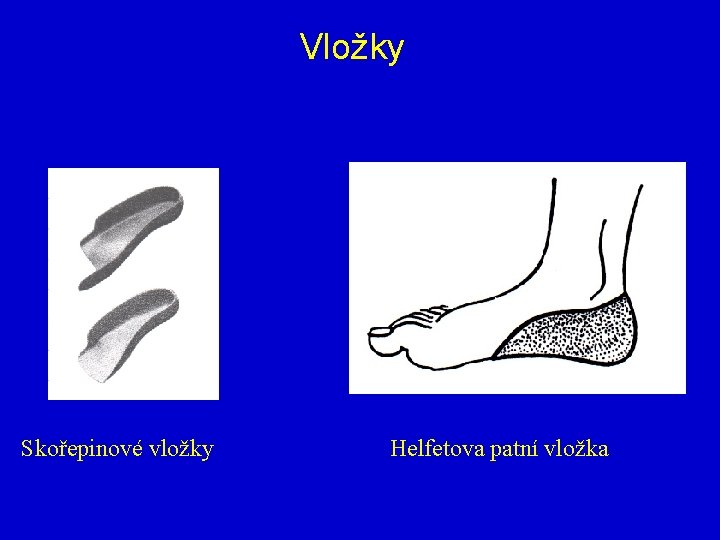 Vložky Skořepinové vložky Helfetova patní vložka 