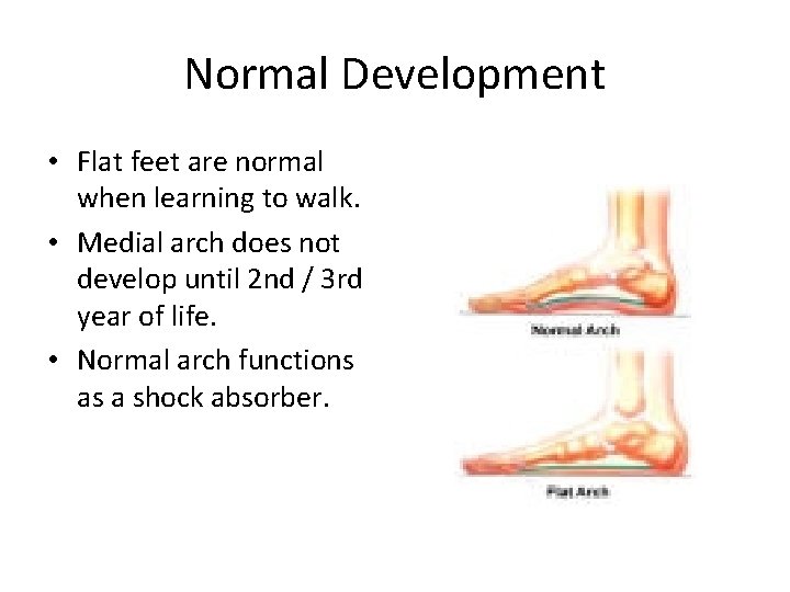 Normal Development • Flat feet are normal when learning to walk. • Medial arch