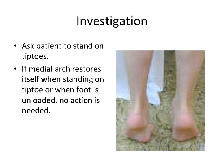 Investigation • Ask patient to stand on tiptoes. • If medial arch restores itself