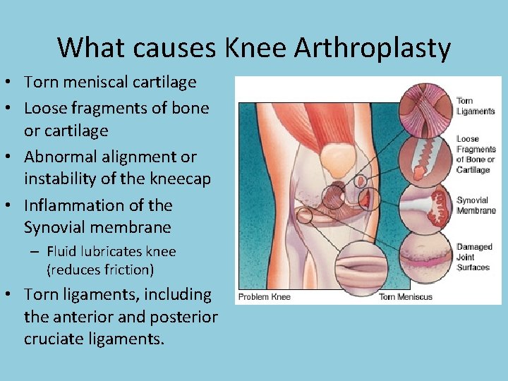 What causes Knee Arthroplasty • Torn meniscal cartilage • Loose fragments of bone or